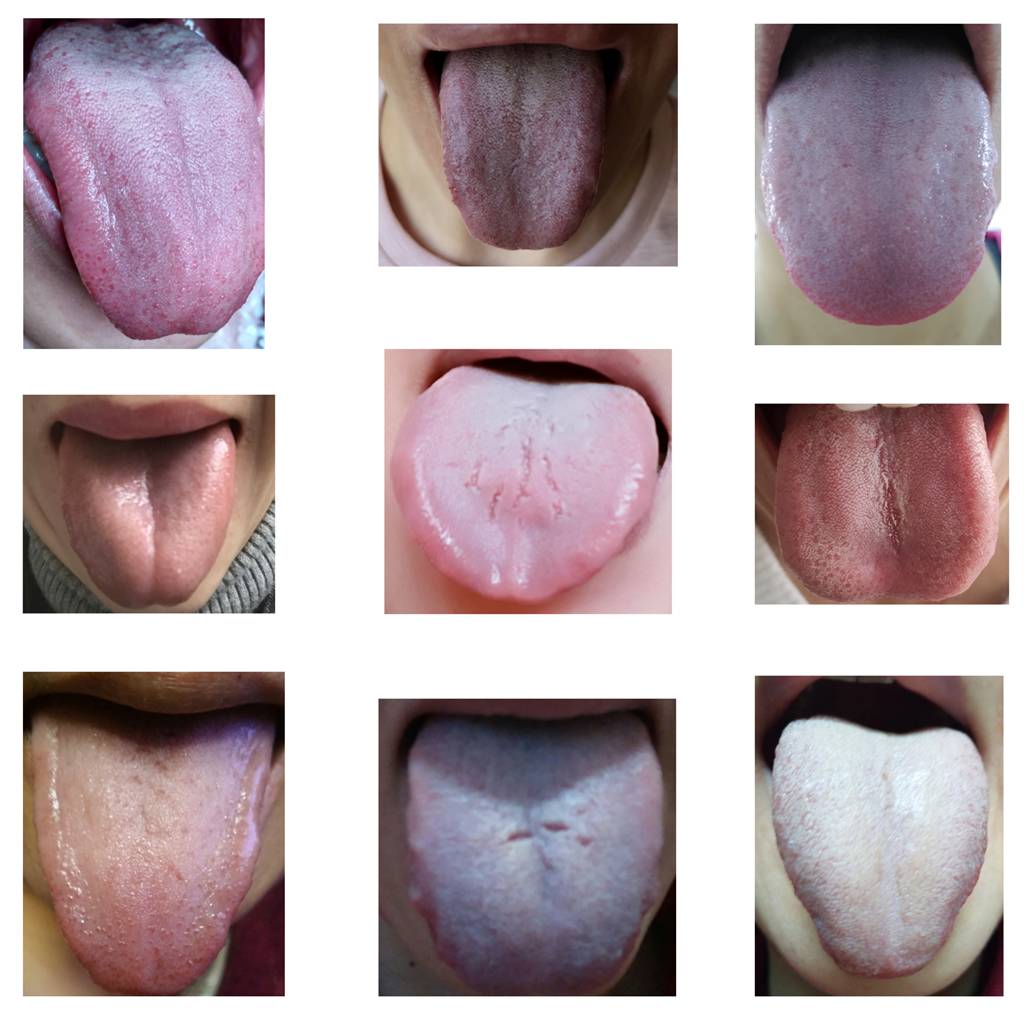 正常舌苔图片 阴虚图片