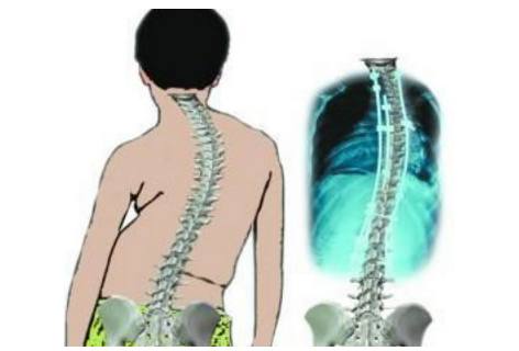 强直性脊柱炎—百病因脊柱变形而引起,压迫五脏六腑