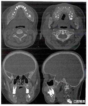 下頜骨唇,頰側以及整個上頜骨骨皮質影像消失,牙周支持組織包括牙周膜