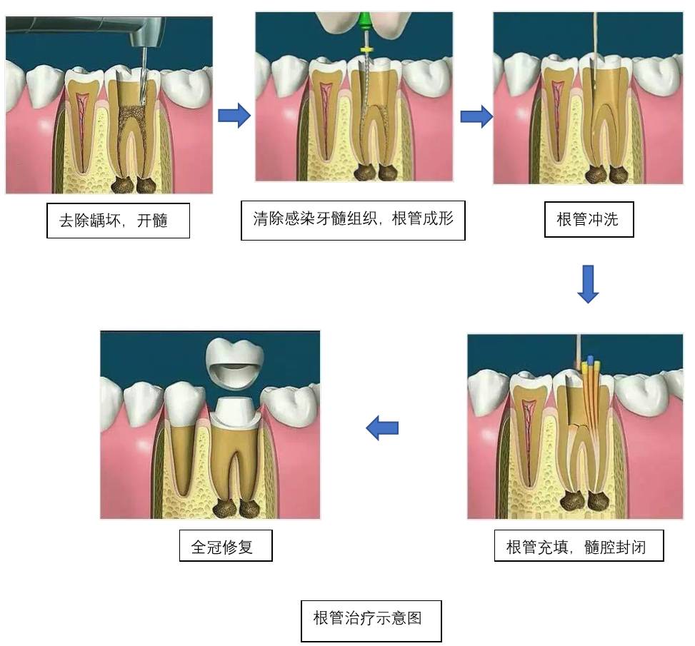 医生,我牙疼!什么是根管治疗?是传说中的杀神经吗?