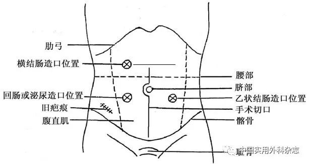 乙状结肠造口位置图片