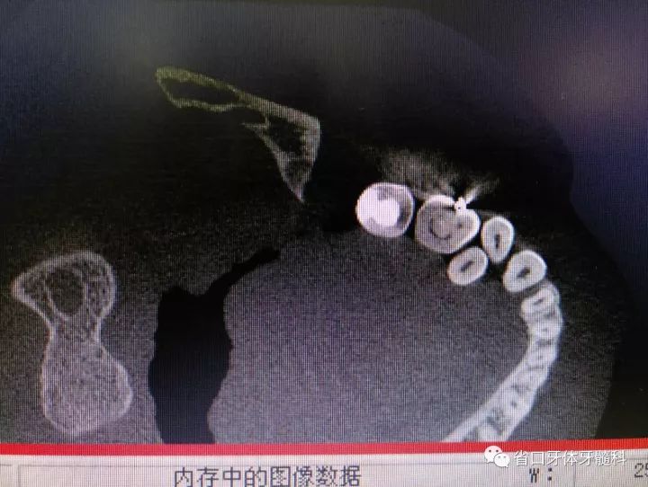 病例分享下頜牛牙症根管治療一例