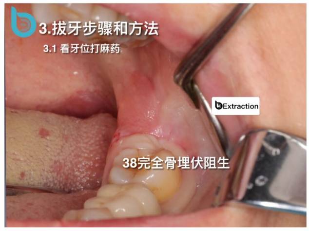 下頜低位阻生智齒拔除完全骨埋伏阻生微創拔牙導板拔牙