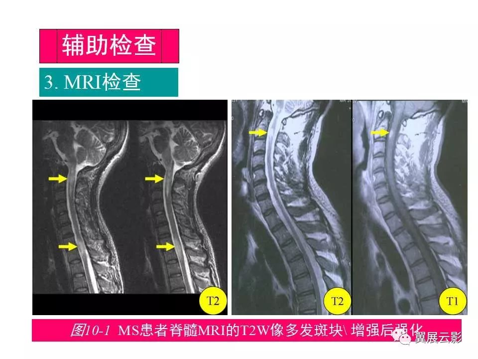 中樞神經系統脫髓鞘疾病