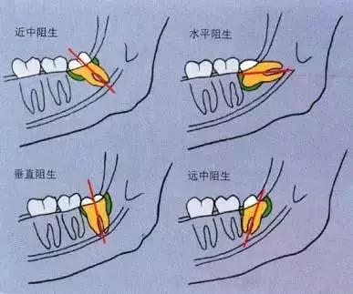 拔乳牙技巧图解图片