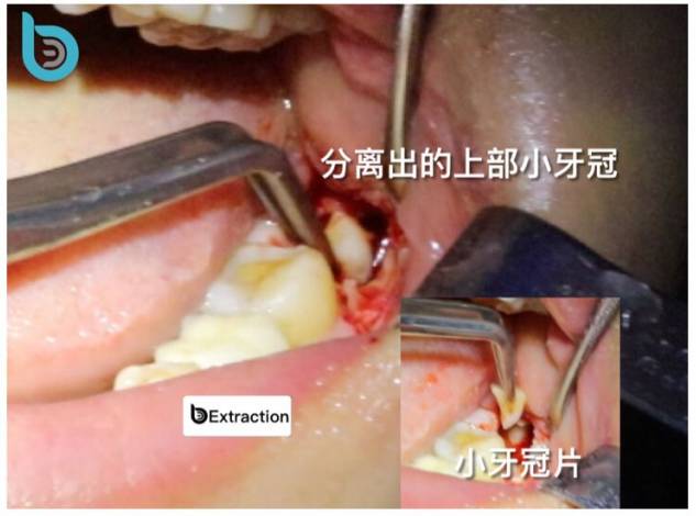 下頜低位阻生智齒拔除完全骨埋伏阻生微創拔牙導板拔牙