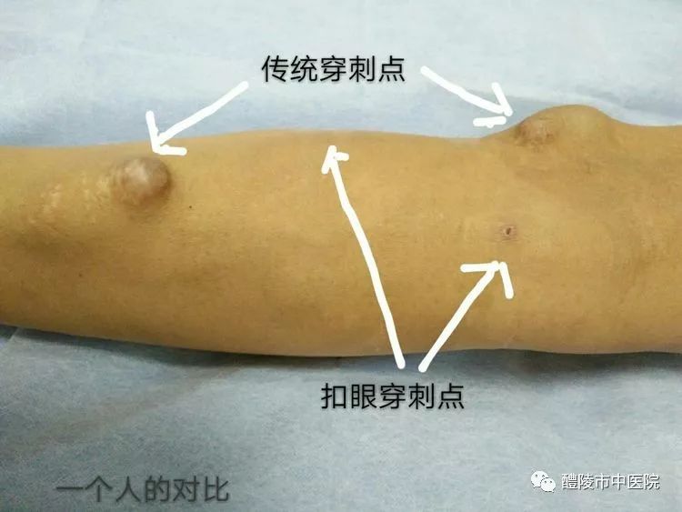 锐针注射方法图片