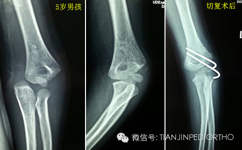 4岁儿童肘关节x片图片