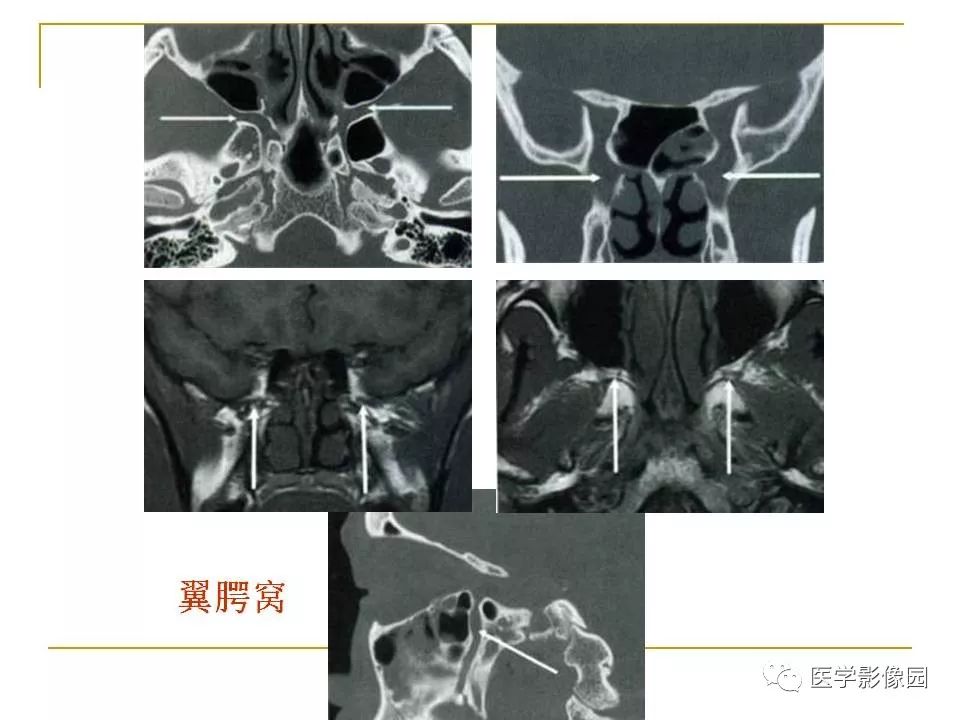 翼腭窝影像解剖及常见病变丨影像天地