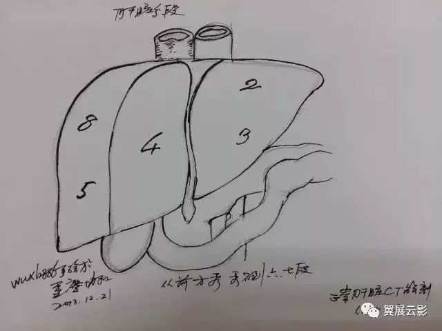 讀懂肝臟ct片原來這麼簡單