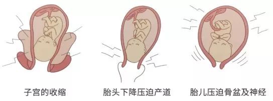 临产的宫缩图图片