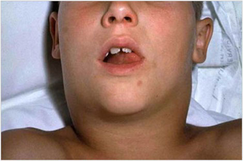 白喉病人的扁桃体和咽部高度肿胀,阻塞咽门,可影响呼吸