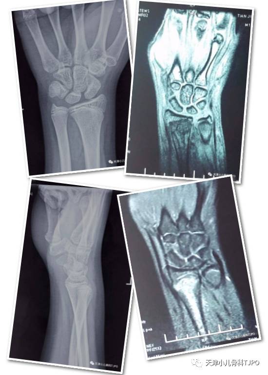 男 不慎摔倒答:孩子手腕腫脹明顯,壓痛主要在橈骨遠骺板水平;x線片