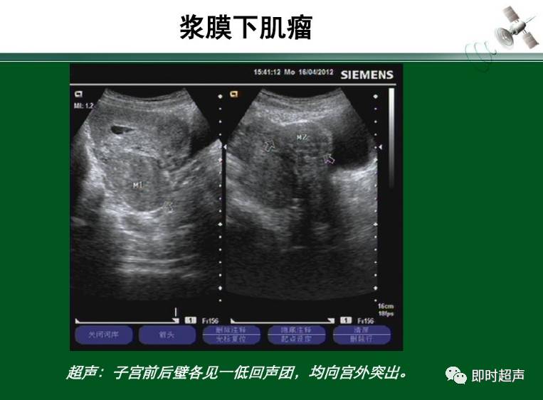 子宫肌瘤的超声诊断与鉴别