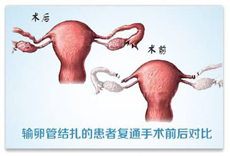 什麼是輸卵管復通手術?