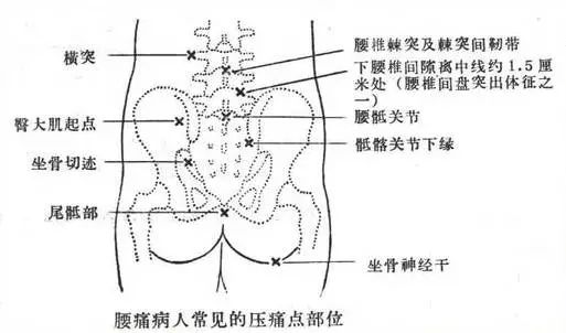 腰椎间盘突出疼痛点图图片