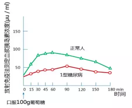 服糖刺激后胰岛素分泌不增加或增加甚微,呈低平曲线;提示1型糖尿病;2