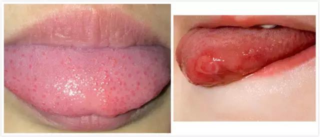 症状表现:如果感冒的时候孩子的舌尖舌边小红点迅速增多,甚至整个舌面