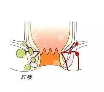 患了高位肛瘘,有没有不痛苦的治疗方法?