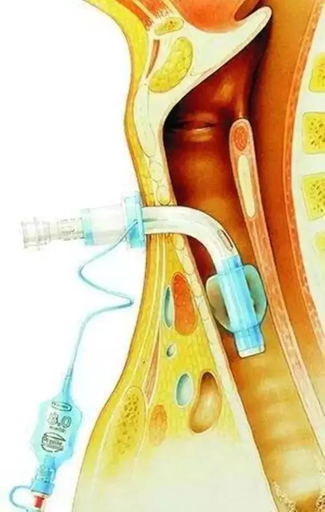 气管胃管的解剖图图片