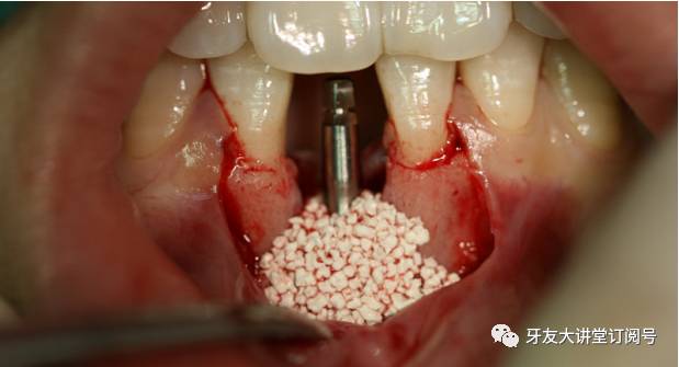 种植牙手术植骨是怎么回事?