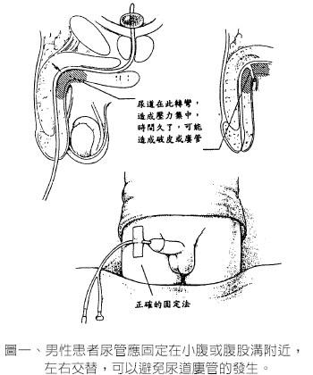 拔导尿管步骤图解图片
