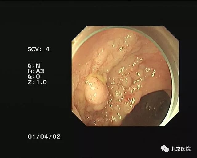北京医院消化内科完成1例低位直肠巨大侧向发育型肿物内镜下剥离术