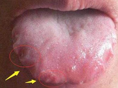 年轻胃癌的舌苔图片图片