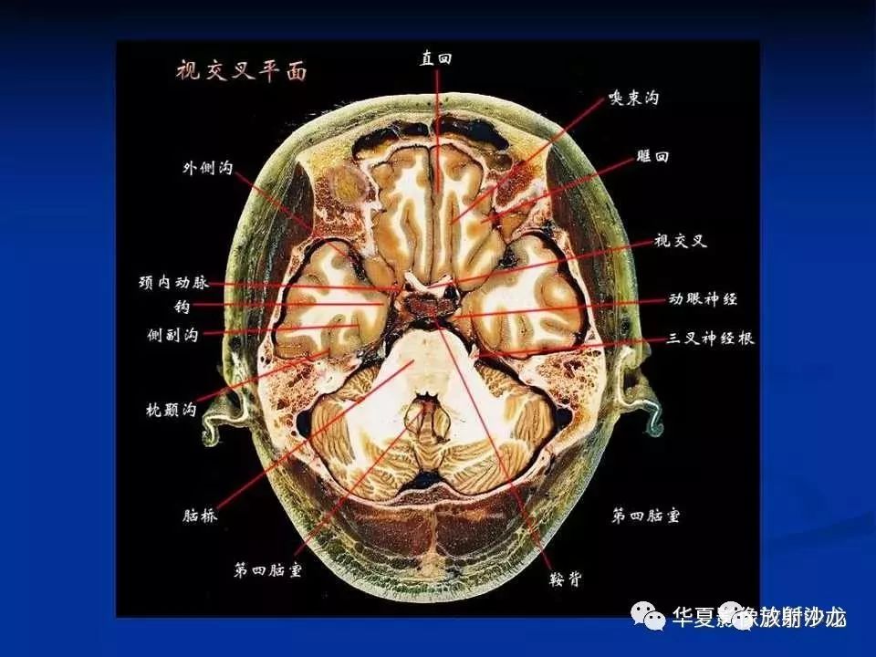 各部位详细标注的大脑断层解剖