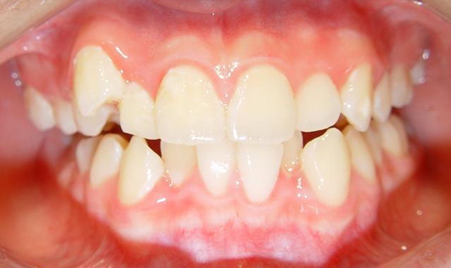 牙列拥挤是错合畸形中最常见者,可表现为牙齿拥挤错位排列不齐