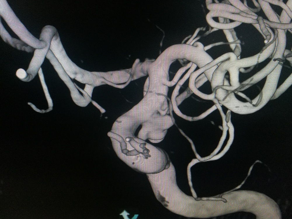 动脉瘤支架颅内动脉瘤图片