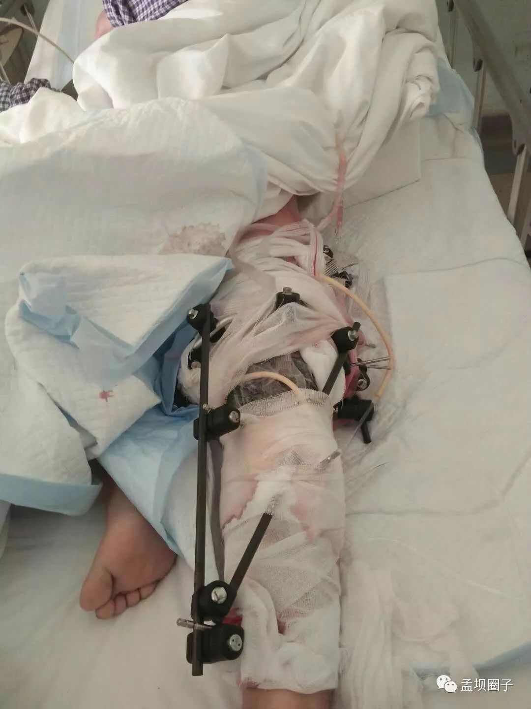 孟坝11月26日车祸,受伤者左腿粉碎性骨折最新情况!