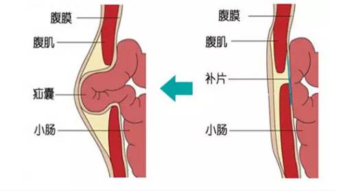 腹股沟疝气位置图片图片