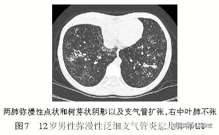 专题笔谈│细支气管炎影像学特征