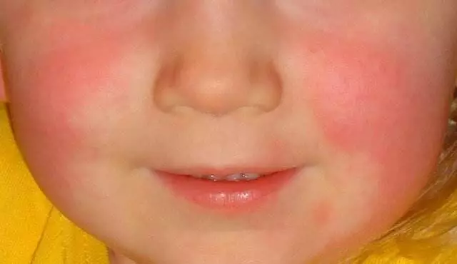 宝宝两颊及前额充血潮红,但没有皮疹,口鼻周围呈现出特征性口周苍白