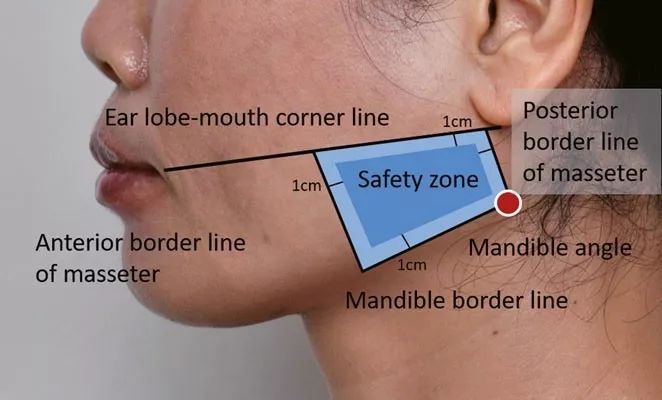 咬肌注射点位置图图片