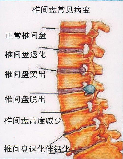 腰间盘突出复位图解图片