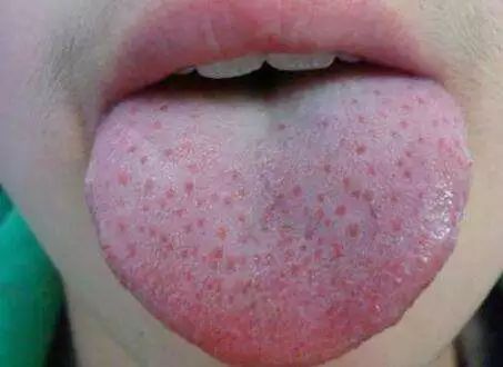 舌头逐渐变得光滑,舌乳头呈绛红色突起,形似草莓