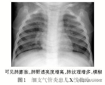 哮喘x线图片图片