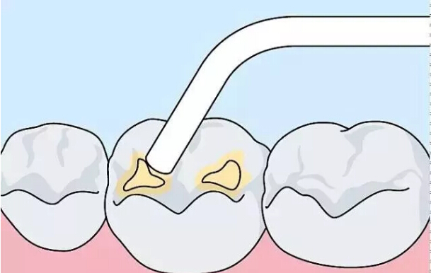 乳磨牙3-4歲. 做窩溝封閉詳細過程 第1步