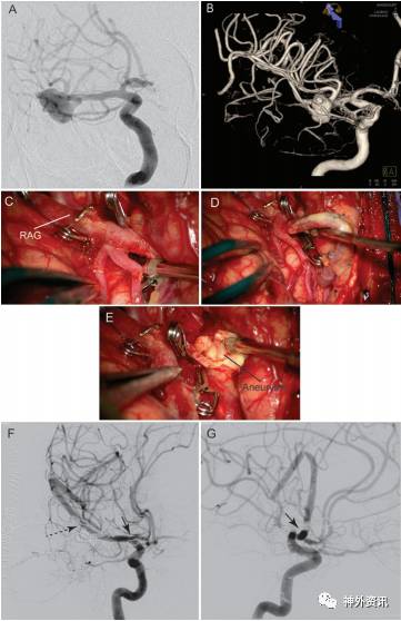 处理复杂性大脑中动脉动脉瘤的搭桥术设计