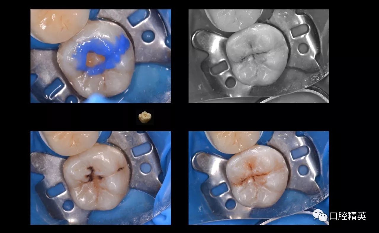 口腔二类洞制备步骤图片