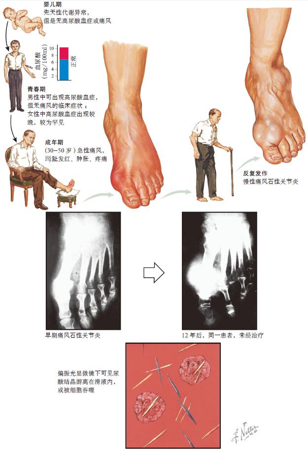 認識痛風丨圖解科學