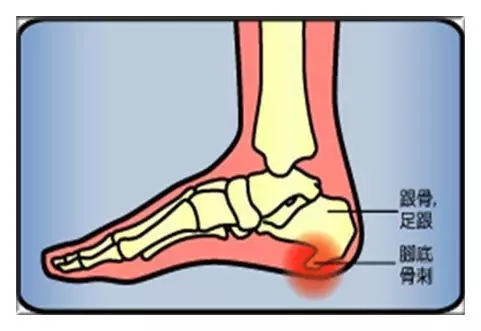 足跟骨刺 跟骨退行性改变导致的骨质增生,即"骨刺,也是导致足跟痛的