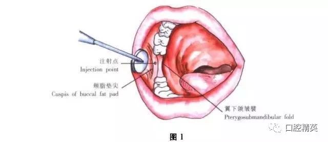 舌神经阻滞麻醉图片