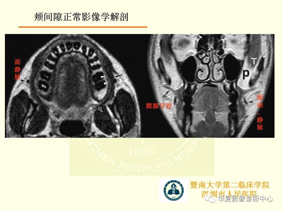 颊间隙影像学解剖与病变的诊断