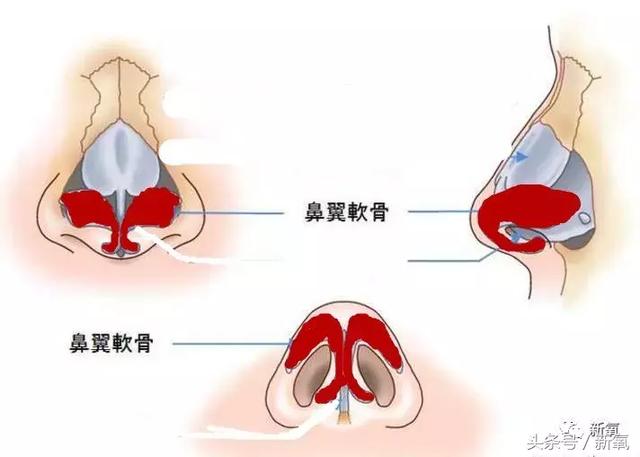 鼻中隔高度越高,鼻尖高度和鼻小柱高度就越高(原裝的情況下).