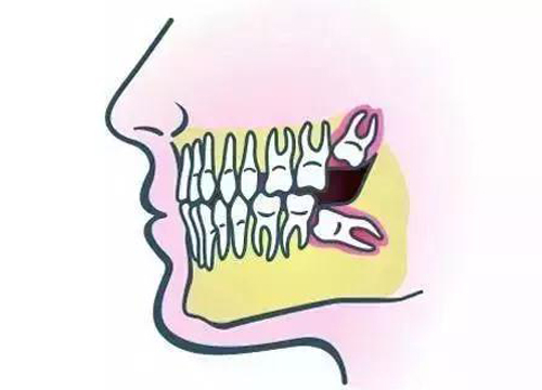 這五類智齒你不拔,帶給你的將是疼痛