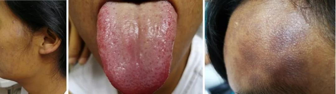肝硬化病人的舌头图片图片