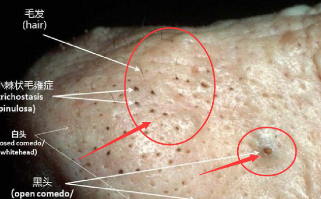 黑头粉刺清晰图片图片
